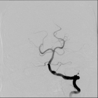 image5-acute-treatment-of-ruptured-fusiform-v4-aneurysm-diagnostic-angio-1