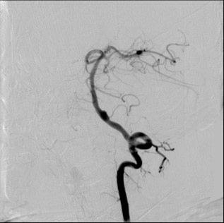 image6-acute-treatment-of-ruptured-fusiform-v4-aneurysm-diagnostic-angio-2