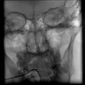 image8-acute-treatment-of-ruptured-fusiform-v4-aneurysm-pipeline-flex-flow-divert-1