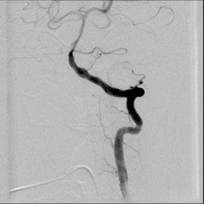 image9-acute-treatment-of-ruptured-fusiform-v4-aneurysm-pipeline-flex-flow-divert-2