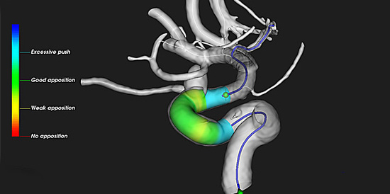 Virtual stenting on a 3D screen 