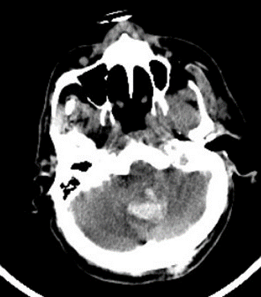 Initial brain CT: Cerebellar hemorrhage