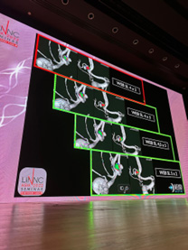 The last cases were focused on brain AVM embolizations