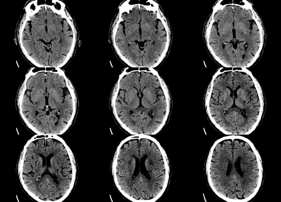 Non contrast CT revealed acute infarction