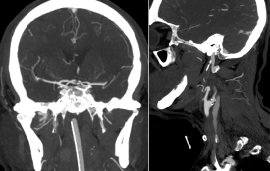 CTA showed intracranial M2 occlusion