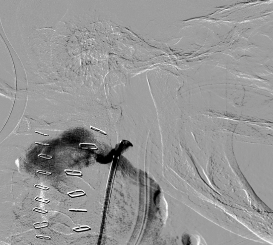 massive contrast extravasation