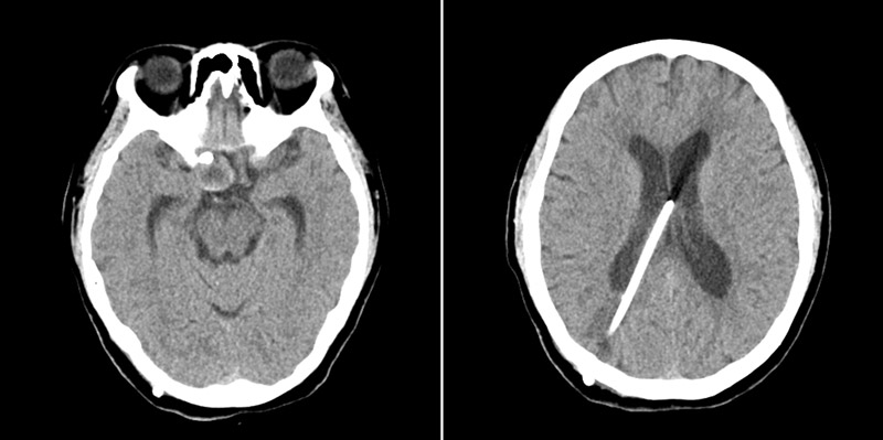 2-month FU without infarction or rebleeding