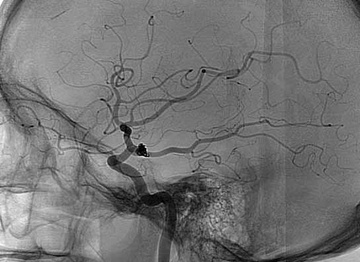 Final DSA from initial acute treatment by second operator demonstrating good result
