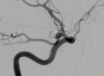 Conventional DSA demonstrating significant early recurrence