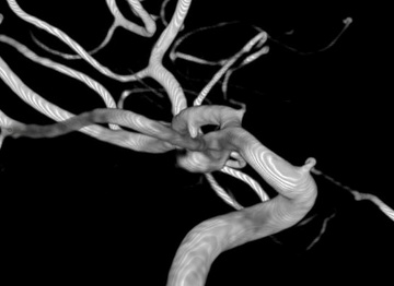 3D rotational DSA demonstrating recurrence involving both the true foetal Pcom and ICA