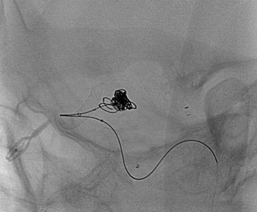 Atlas in foetal Pcom and PED-Shield in ICA - Aneurysm coiled via jailed Headway 17