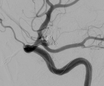 Atlas in foetal Pcom and PED-Shield in ICA - Aneurysm coiled via jailed Headway 17