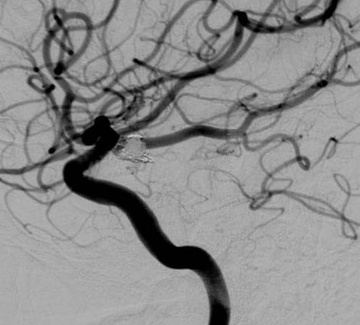 Routine six-month follow-up DSA demonstrating stable, occluded aneurysm without complication