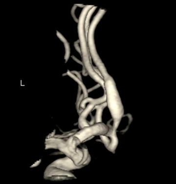 3D rotational angiography demonstrating A2 fusiform aneurysm