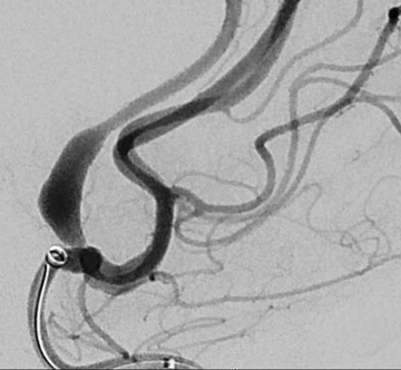 Conventional DSA demonstrating A2 fusiform aneurysm. Sofia 6 in A1