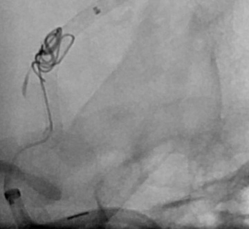 PED-Shield deployed across aneurysm with Headway Duo jailed and aneurysm coiling proceeding
