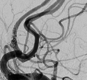 Final working projection demonstrating Raymond-Roy 1 aneurysm occlusion and reconstruction of the at-risk A2