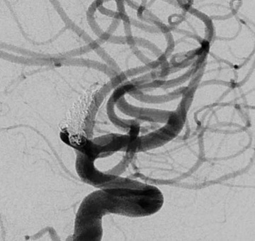Follow-up DSA at 14 weeks post-op demonstrating stable aneurysm cure without complication