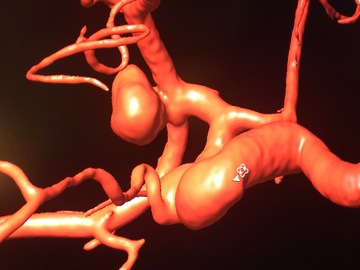 Two aneurysms in same artery
