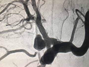 Two aneurysms in same artery