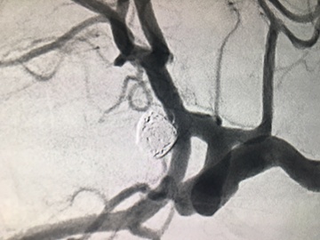 Two different treatment modalities