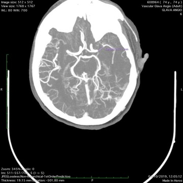 Vascular Glava Angio