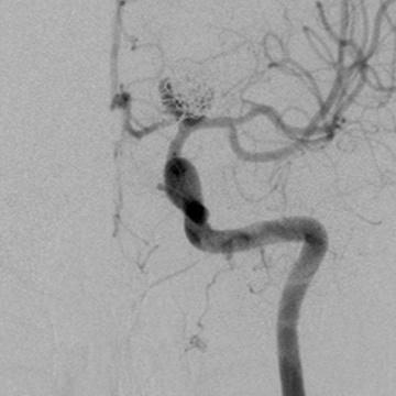 Aneurysm regrowth