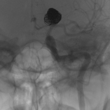 Aneurysm regrowth