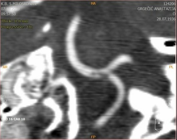 CT Angio 1