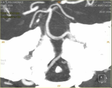 CT Angio 3