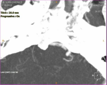 CT Angio 4