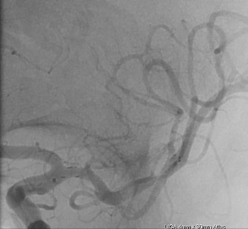 Atlas 4 x 30 mm deployed demonstrating excellent luminal restoration and distal flow.