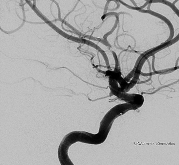 Focal platelet aggregation at the mid to distal Atlas. This was successfully treated with Abciximab.