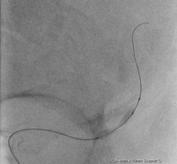 Scepter C 4 x 10 mm angioplasty demonstrating focal waisting of the balloon