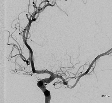Initial DSA demonstrating focal, smooth stenosis of the superior division proximal M2