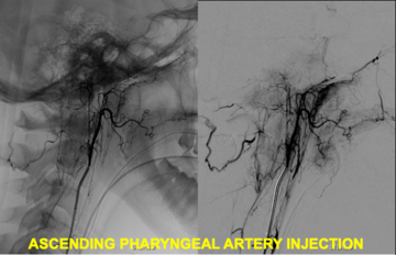 Angiogram 1