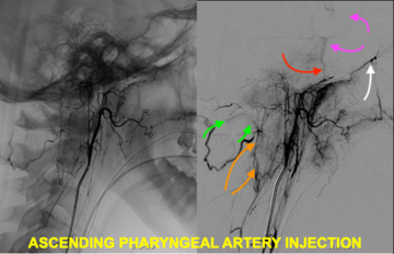 Angiogram 2