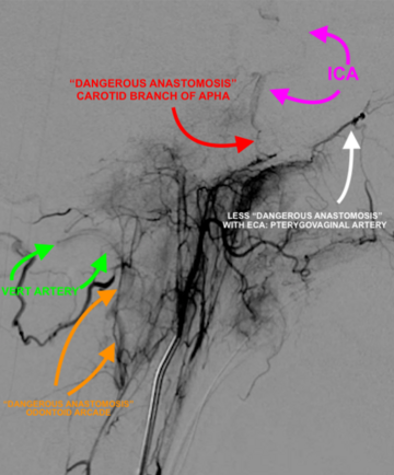 Angiogram 3