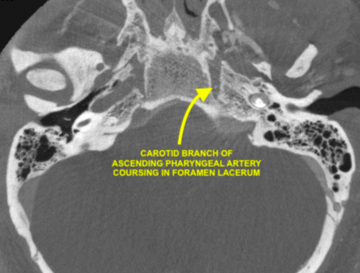 Angiogram 4