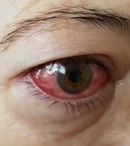 Red eye
