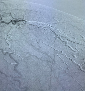 Complete occlusion