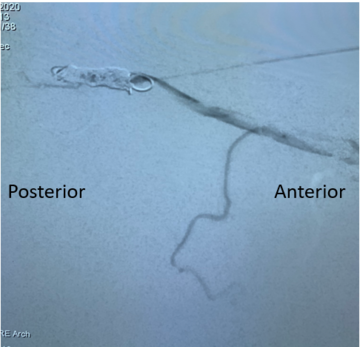 Needle contrast injection