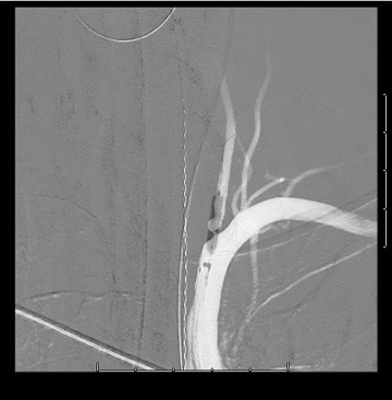 Balloon inflation to nominal pressure prior to stent deployment