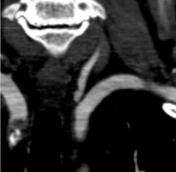 pre-op CTA demonstrating L vert origin stenosis