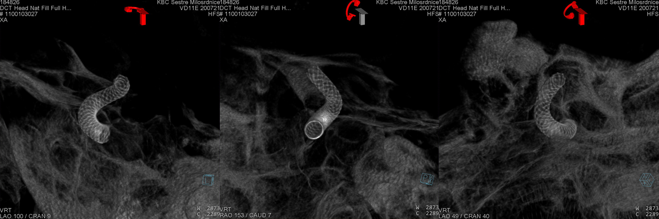 Flow Diverter