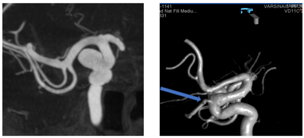 Incidental right paraophthalmic internal carotid artery aneurysm 