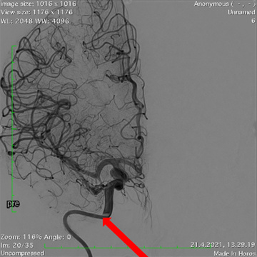 Distal end of the 079 Rist guide catheter 