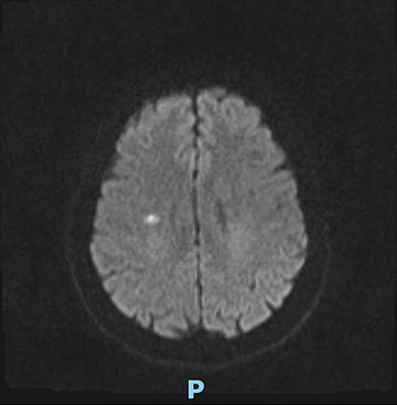 MRI