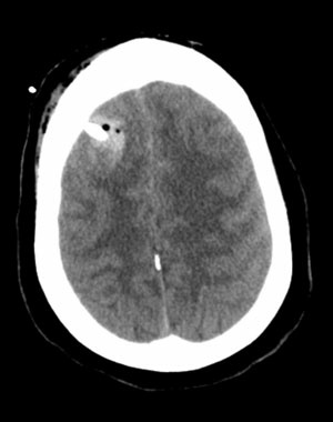 staged-treatment-ruptured-giant-aneurysm-s11-1-a-tract-hemorrhage