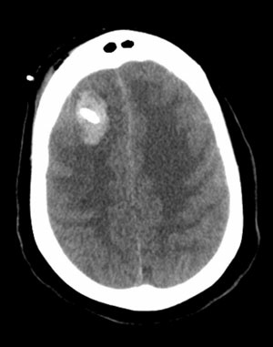 Delayed CT head revealed a tract hemorrhage that was stable on repeat scans